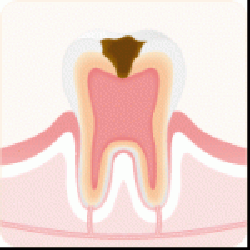 C3：歯髄まで進行